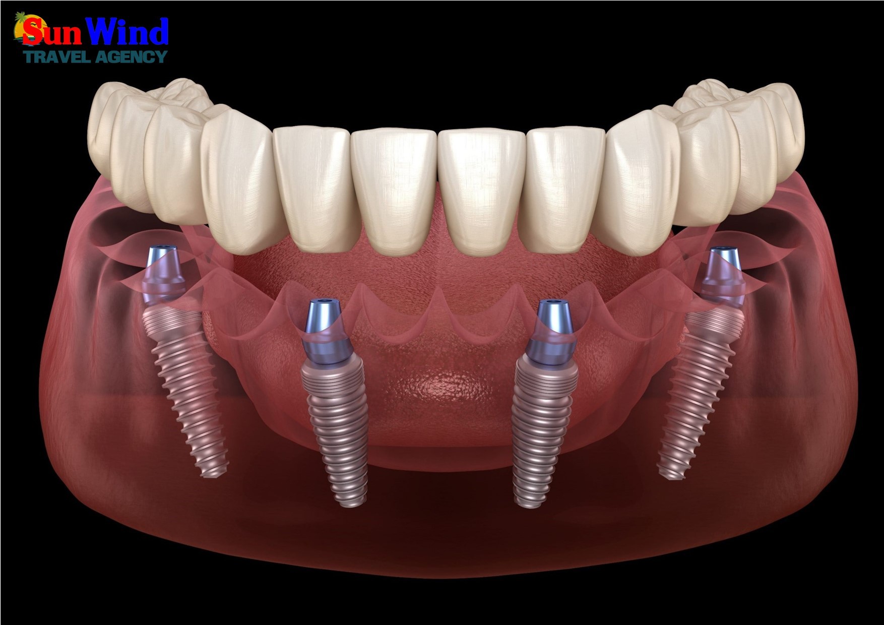 Implant Treatment