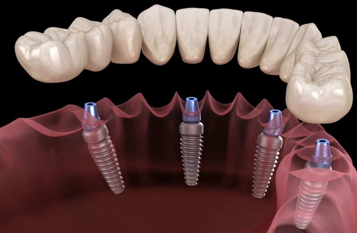 Implant Treatment